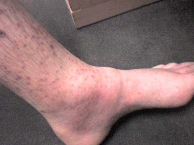 rashes on lower legs